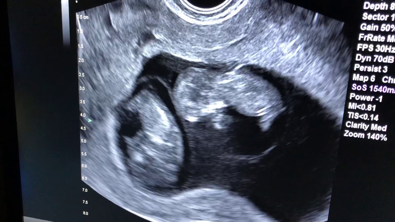 Ultrasounds Of Identical Twins At 8 Weeks Gestation