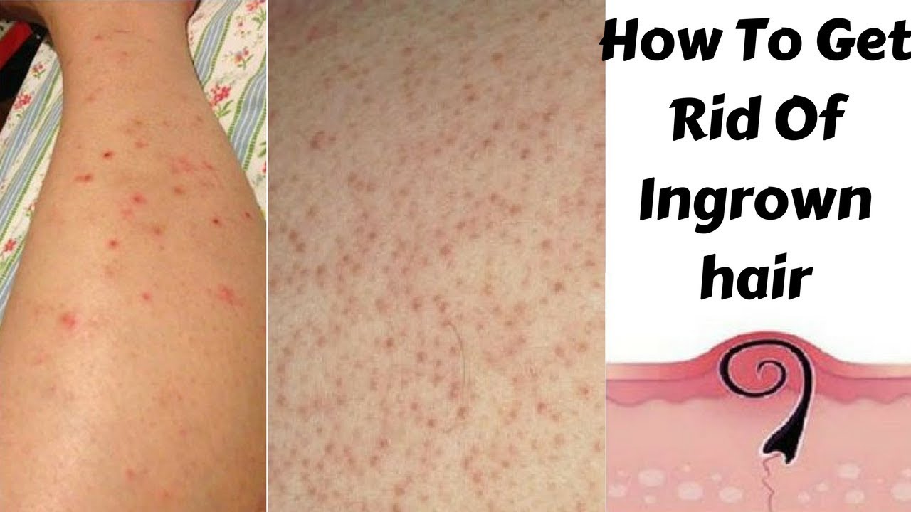 Top 5 Home Remedies To Get Rid Of Ingrown Hair And Red Bumps