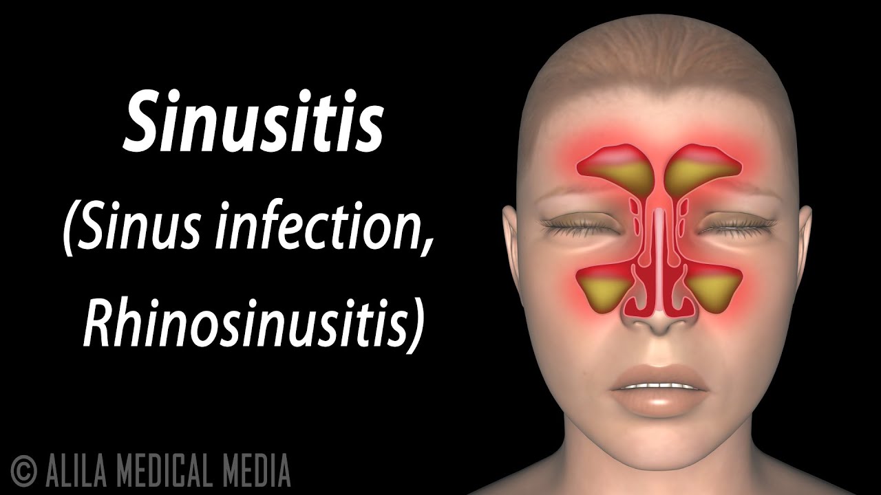 Sinusitis Animation Youtube