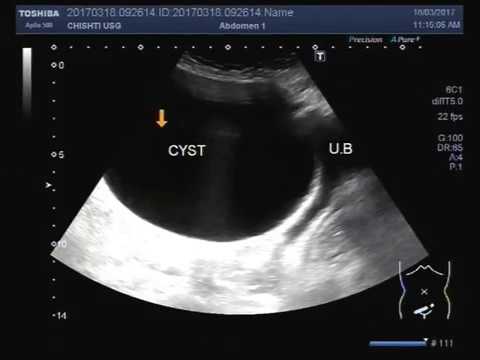 Normal Ovary Cysts Ultrasound