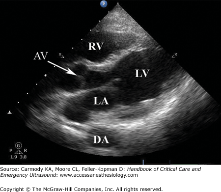 Echocardiography | Anesthesia Key