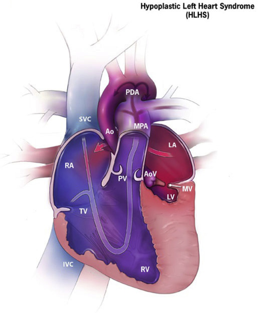 Managing the Adult Patient with Congenital Heart Disease | Anesthesia Key