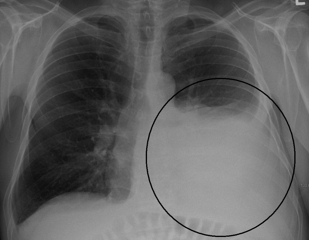 Understanding Icd 10 Pleural Effusion: Causes, Symptoms, And Diagnosis ...