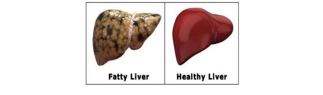 Fatty Liver Disease: Causes, Symptoms, and Treatments – Courtney ...