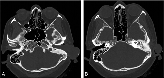 A case of sensorineural hearing loss involving a fibroepithelial polyp ...