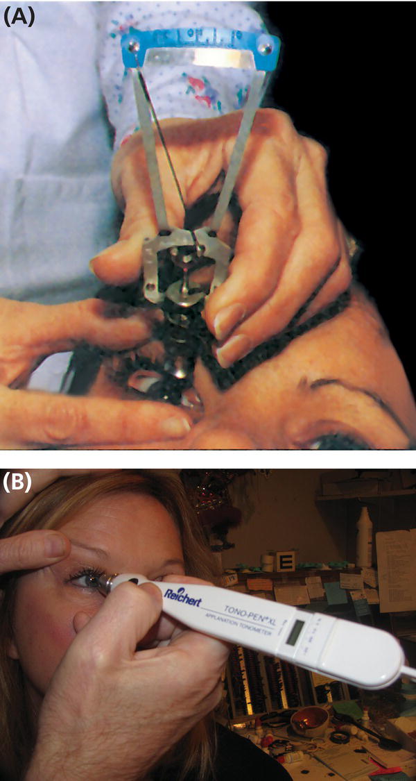 Photo depicts portable tonometers: (A) Schiötz tonometer. (B) Tono-Pen applanation tonometer.