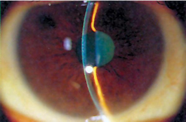 Photo depicts the anterior chamber is the space between the iris and cornea. It is shallow in a short hyperopic eye causing a narrow angle between the surfaces.