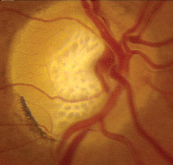 Photo depicts lamina cribrosa forms the floor of optic disk. Note perforations for passage of nerves and blood vessels.