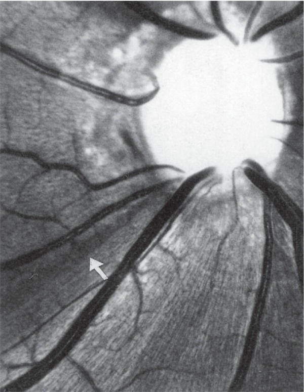 Photo depicts Red-free of glaucomatous cupping and loss of retinal nerve fiber layer. The dark area with loss of striations is pathognomonic of fiber loss if it fans out and widens further from disk.