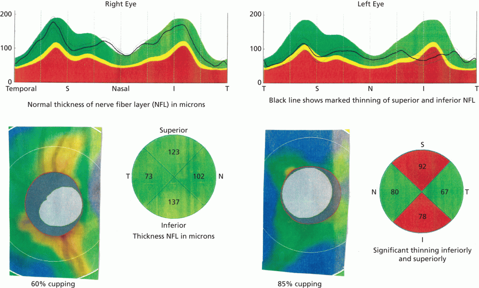 Schematic illustration of OCT of glaucoma left eye showing ganglion cell axon layer thickness and optic cup.