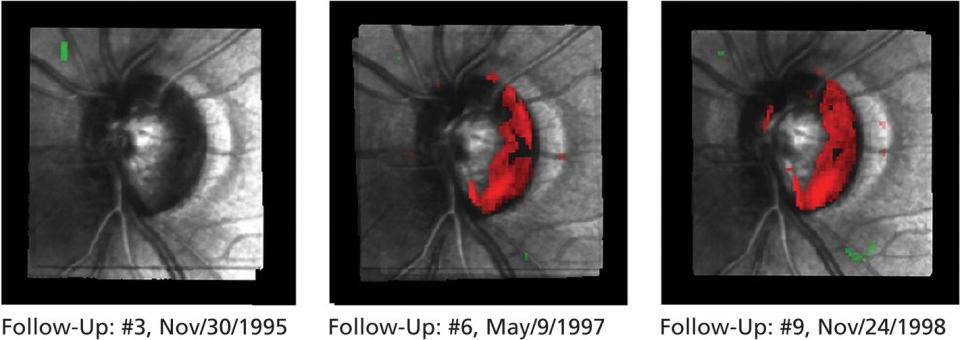 Photo depicts scanning laser optic disk tomography with red color indicating progressive cupping over a 3-year period.