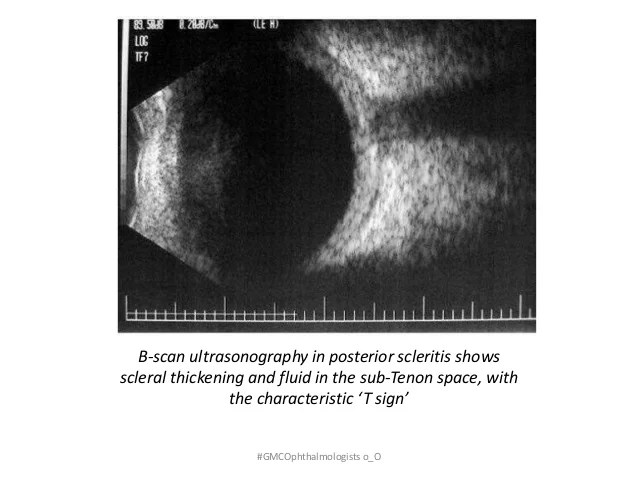 Posterior scleritis is a less common form of scleral inflammation. Scleritis