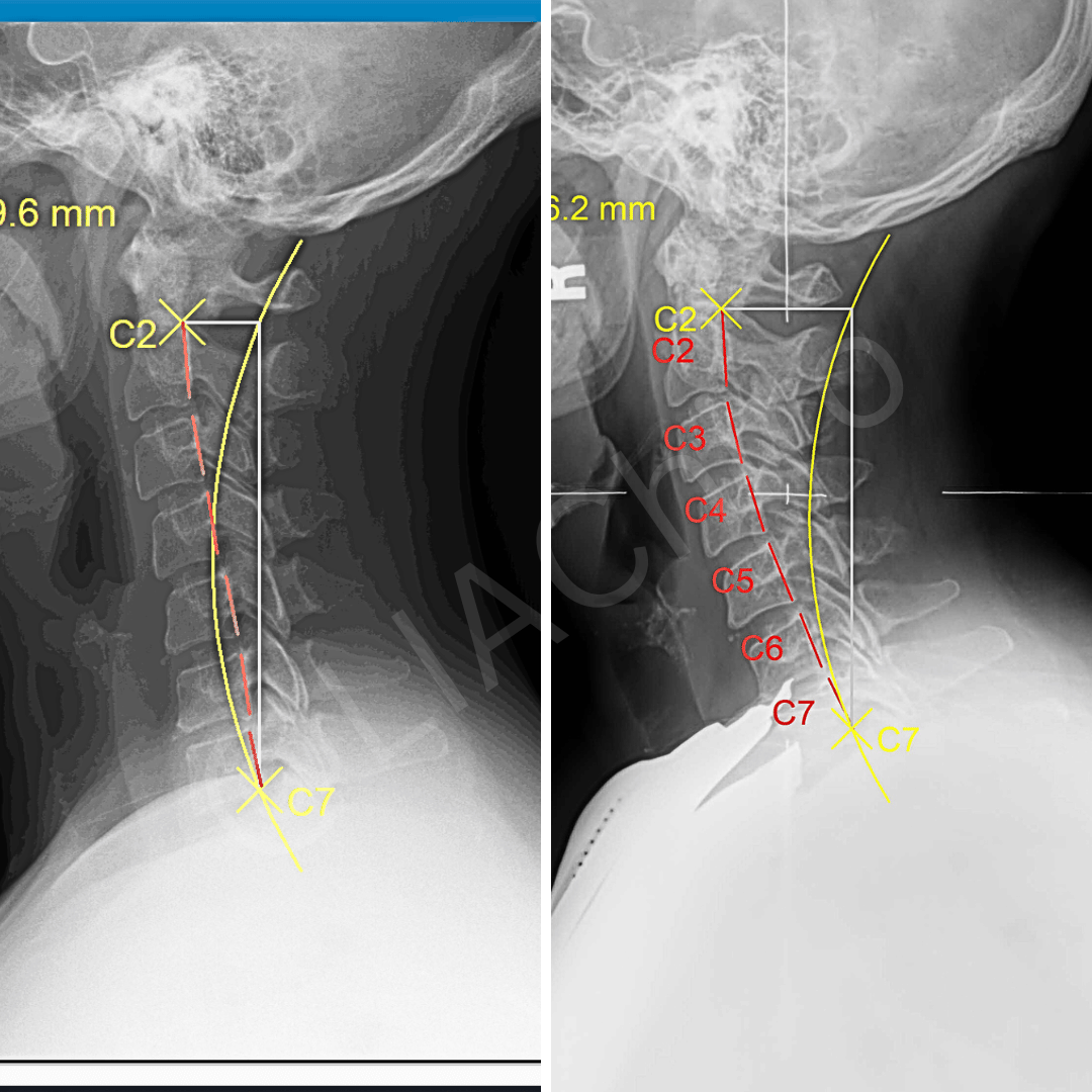 I have a reverse cervical curve. Is this a problem? Can you fix it?