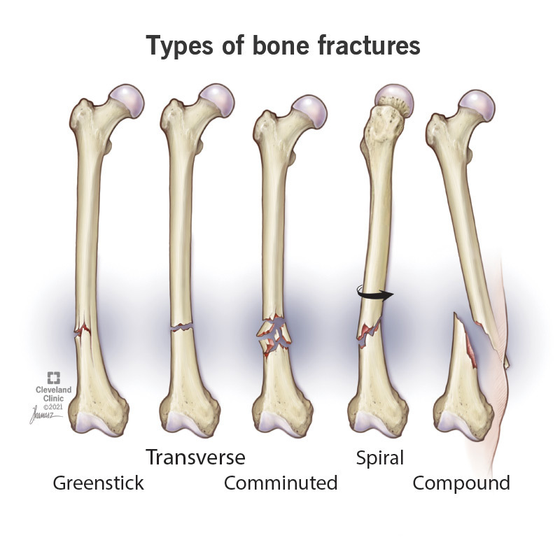 Guide To Bone Fractures Bone Fracture Fractures Fract - vrogue.co