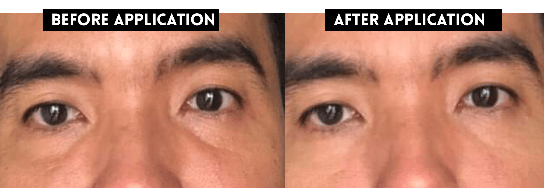 Eye-Puffiness-BEfore-and-After