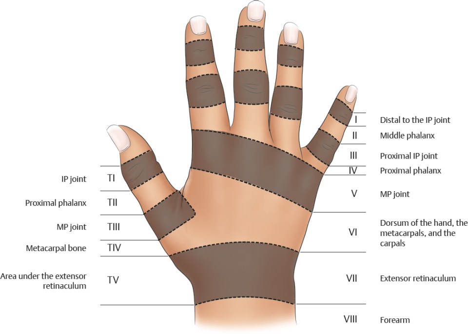 Zones of Extensor Tendon Injuries | Plastic Surgery Key