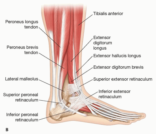 Excision of Soft Tissue Tumors of the Foot and Ankle | Plastic Surgery Key