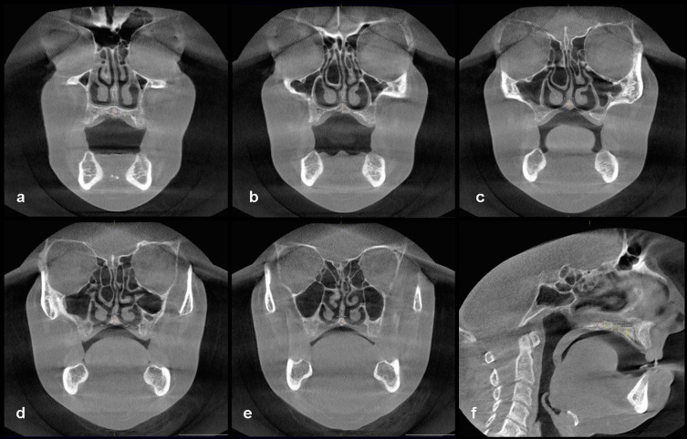 The evaluation of palatal bone thickness for implant insertion with ...