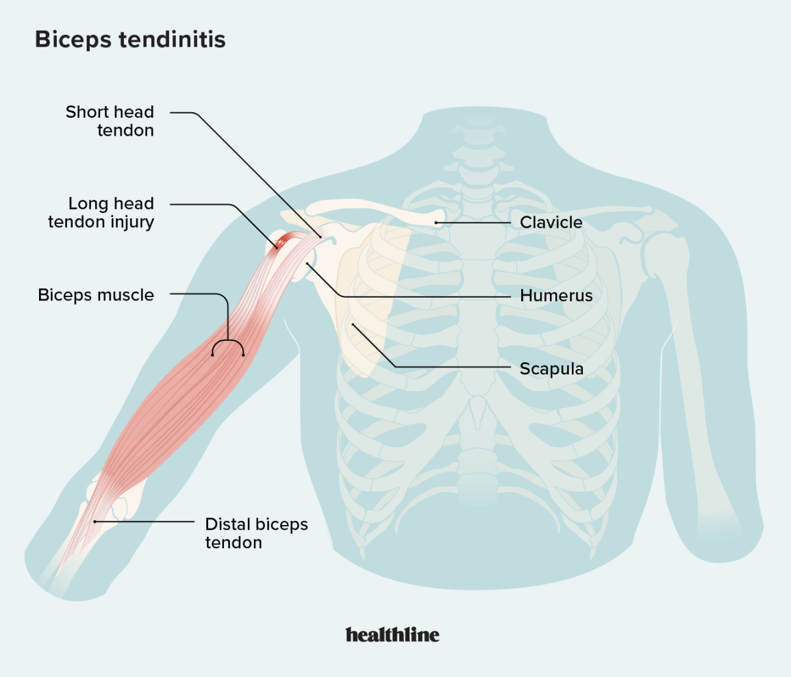 Biceps Tendonitis: How Arthroscopic Surgery Relieves, 51% OFF