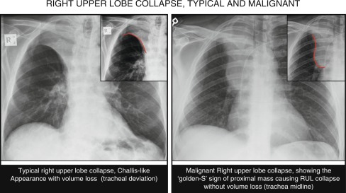 Lung cancer | Thoracic Key