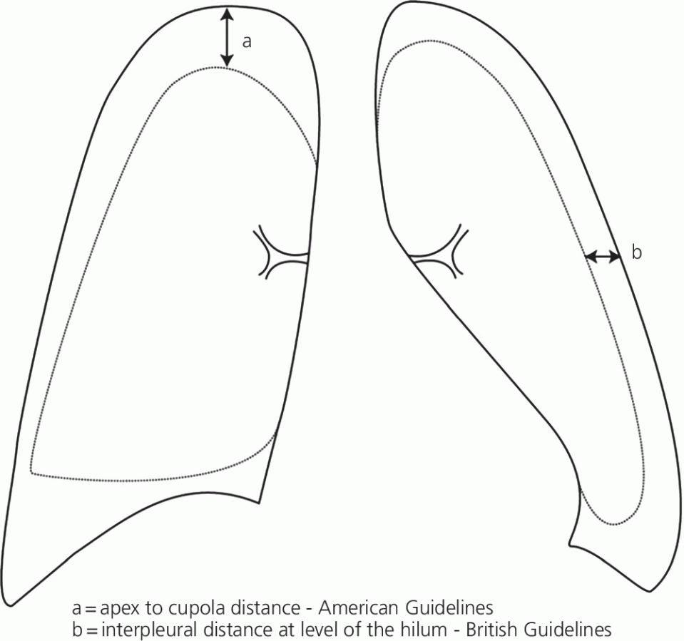 Illustration of the lungs with 2 double-headed arrows labeled a and b depicting the apex to cupola distance and the interpleural distance at level of the hilum, respectively.