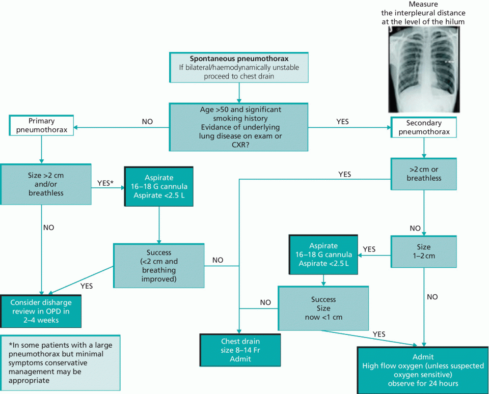 Flow chart of British thoracic society 2010 guideline for management of pneumothorax from spontaneous pneumothorax to primary pneumothorax and secondary pneumothorax (with radiograph on top).