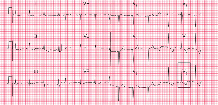 The effects of other conditions on the ECG | Thoracic Key