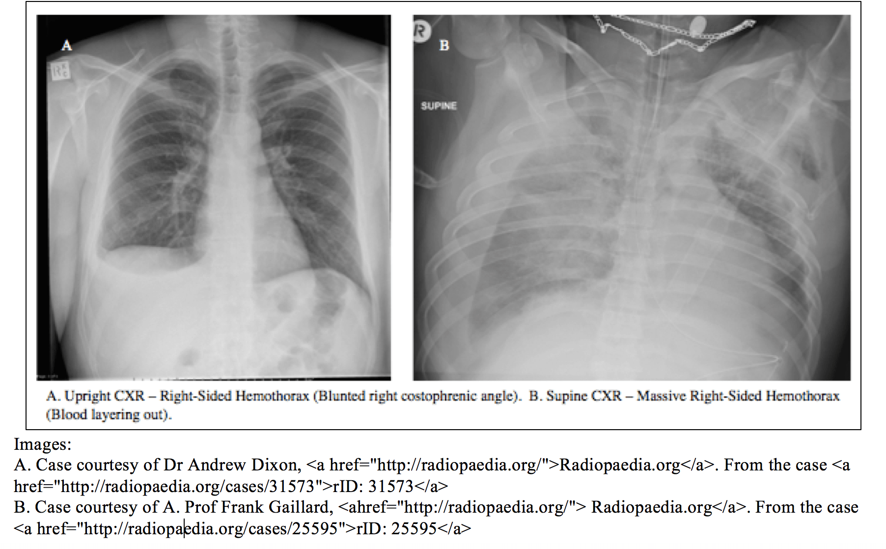 Left Hemothorax X Ray