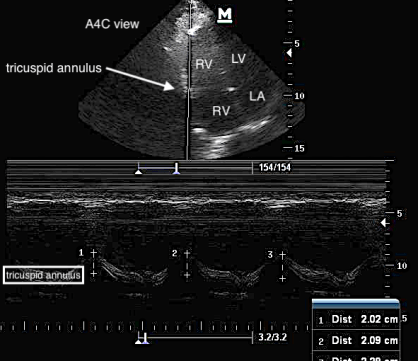 emDOCs.net – Emergency Medicine EducationUS Probe: TAPSE - emDOCs.net ...