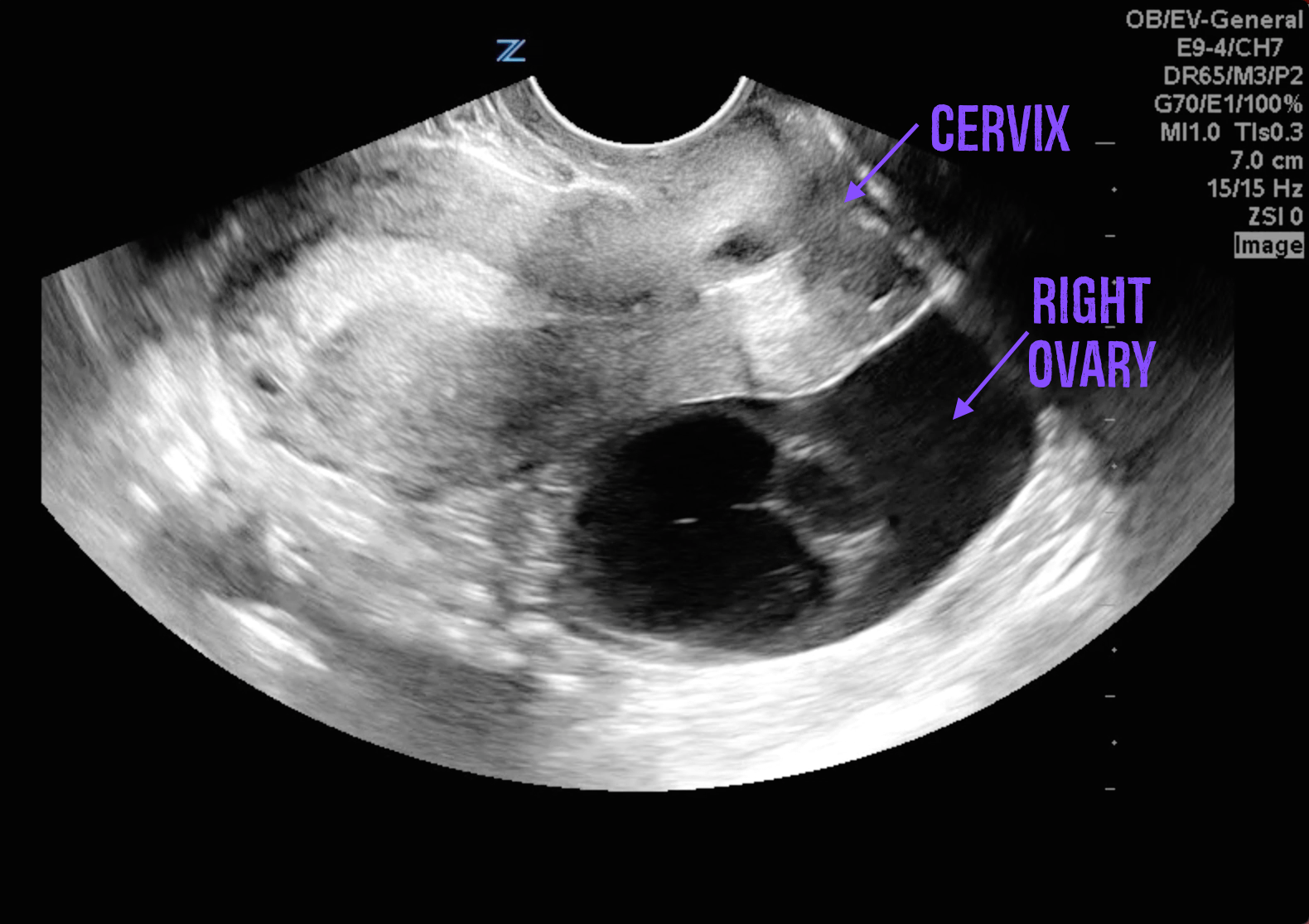 Pelvic Inflammatory Disease Ultrasound