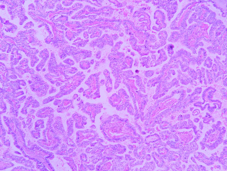 Papillary carcinoma thyroid