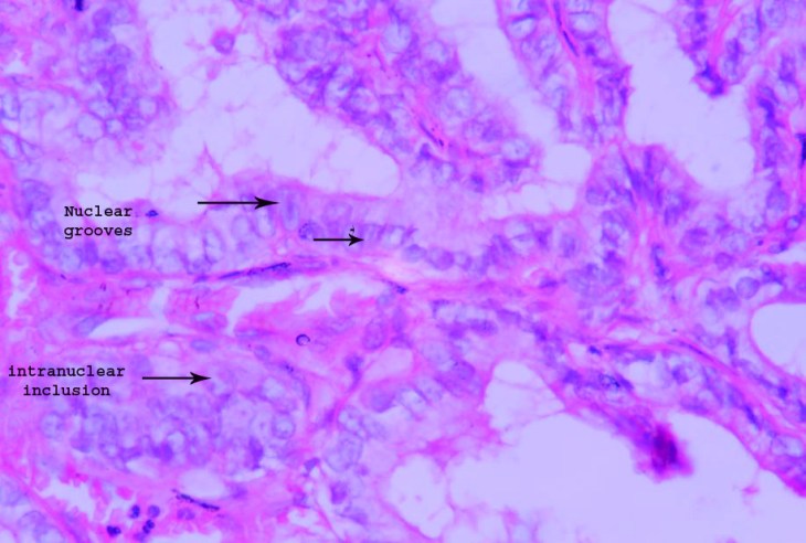 Papillary carcinoma