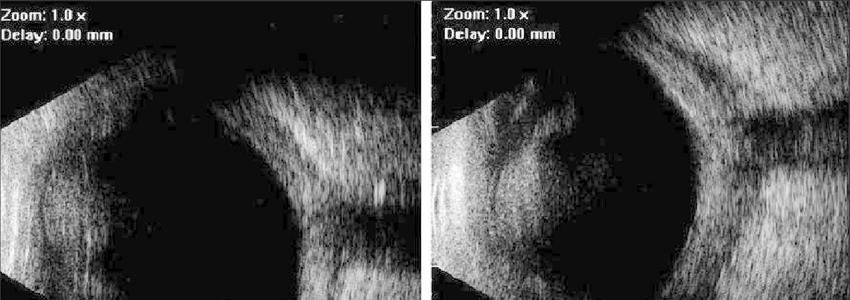 Here's what to do when using. Ocular B Scan Ultrasound Examination Shows Bilateral T Sign Download Scientific Diagram