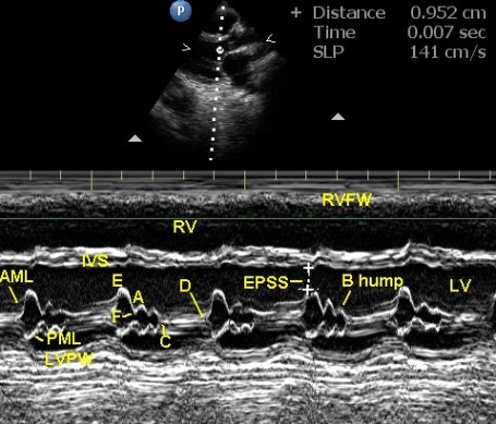 M-mode echocardiogram in left ventricular dysfunction – Cardiophile MD