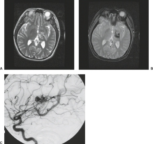 Intracranial Vascular Malformations and Aneurysms | Radiology Key