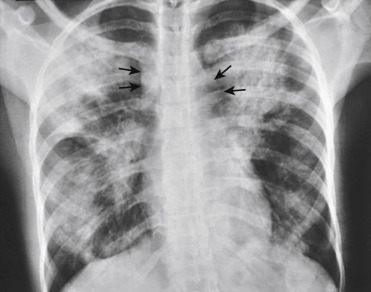 Multifocal Ill-Defined Opacities | Radiology Key