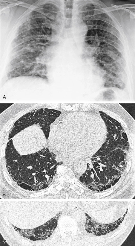 Coarse Reticular Opacities (Honeycomb Lung) | Radiology Key