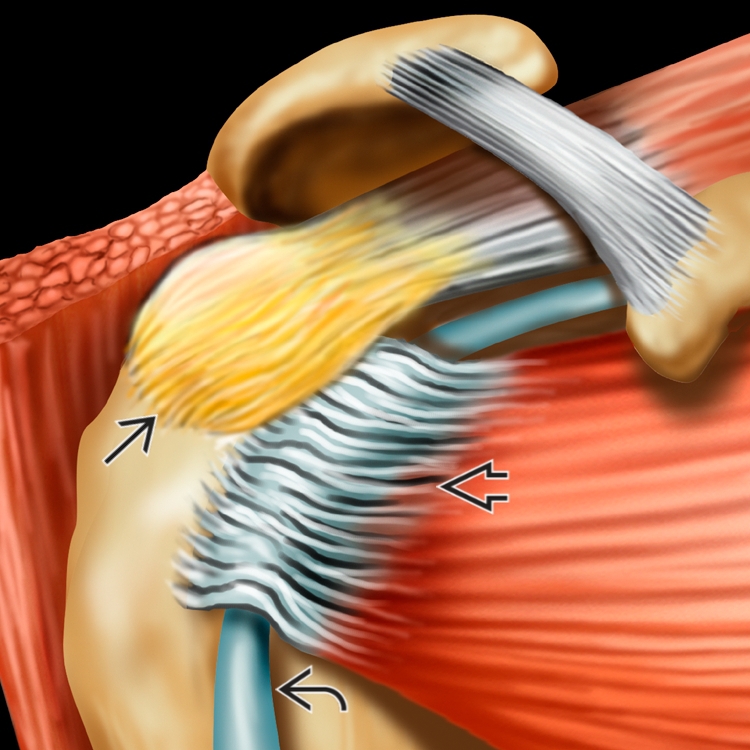 Ultrasound Guided Biceps Tendinitis And Rotator Cuff Tendinitis ...