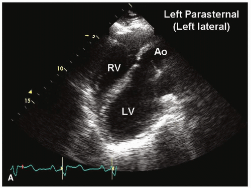 Pericardial Diseases | Thoracic Key