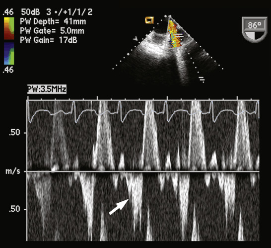 Mitral valve disease | Thoracic Key