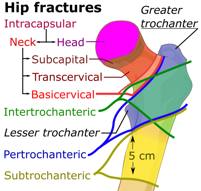 고관절 무혈성괴사증(AVN), 대퇴경부골절 (femur neck fx.) xray : 네이버 블로그