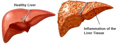 Hepatitis - Inflammation of the Liver| Interactive Health