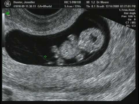 9 weeks 2 days Ultrasound - YouTube