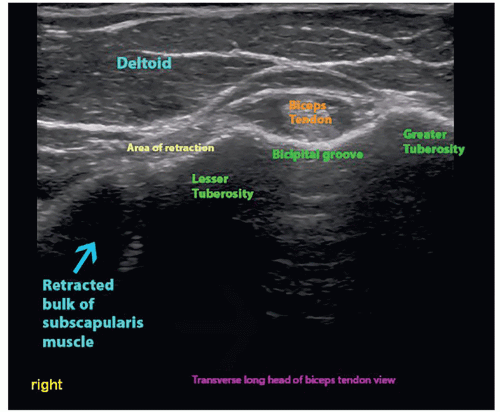 Ultrasound Guided Injection Technique For De Quervain - vrogue.co