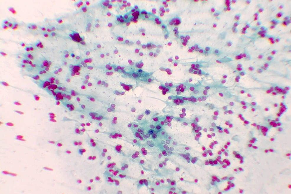 Cureus Comparison of Two Different Methods of Fine Needle Aspiration