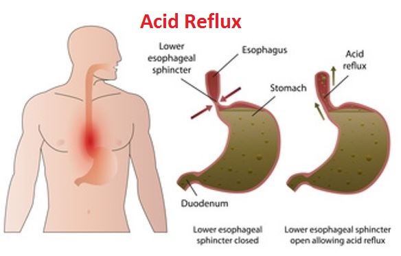 Acid Reflux Test and Diagnosis HealthNormal