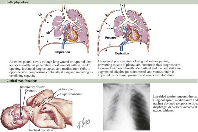 Pleural Effusions and Pneumothorax | Clinical Gate