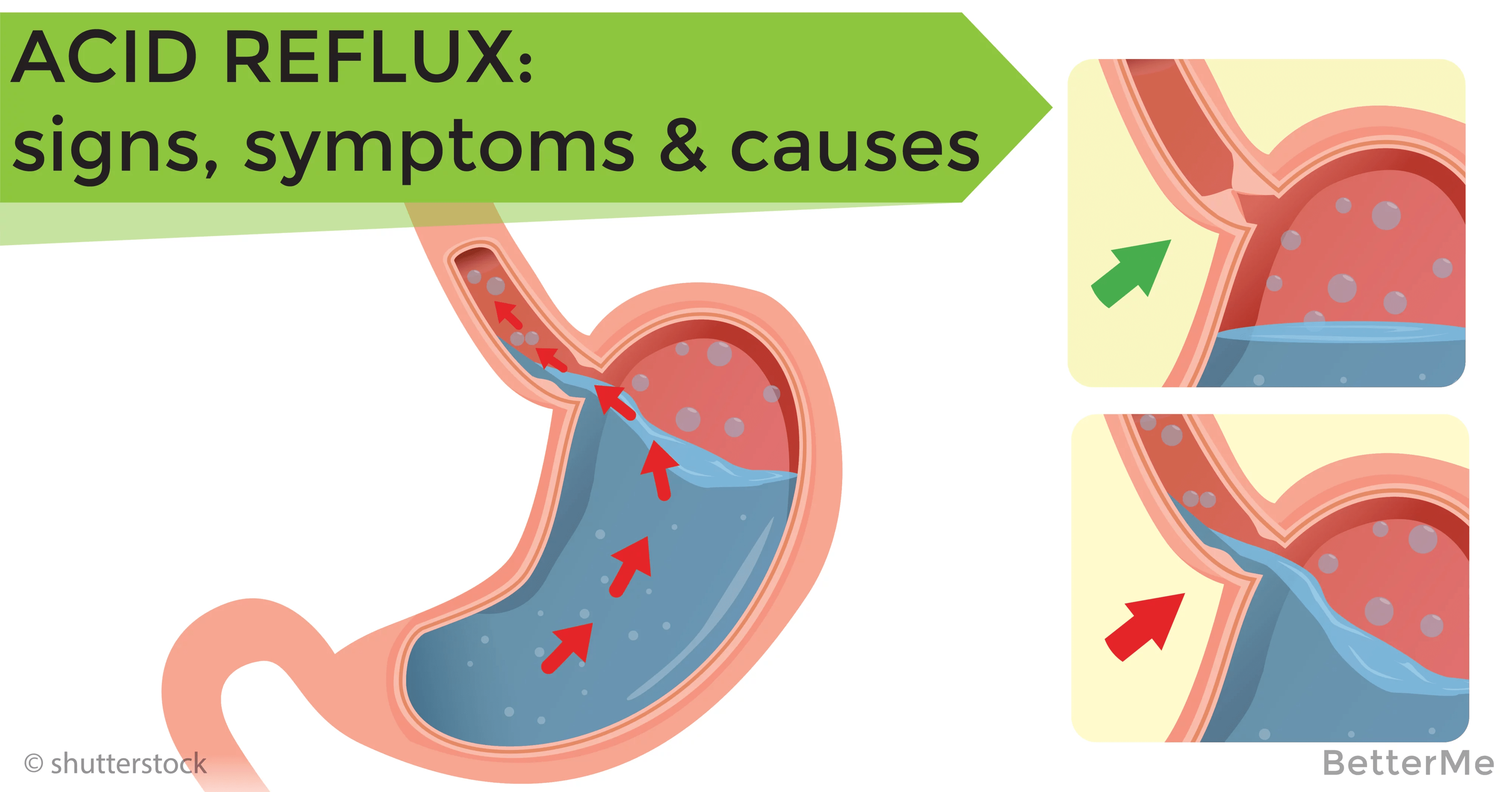 Acid reflux signs, symptoms and causes