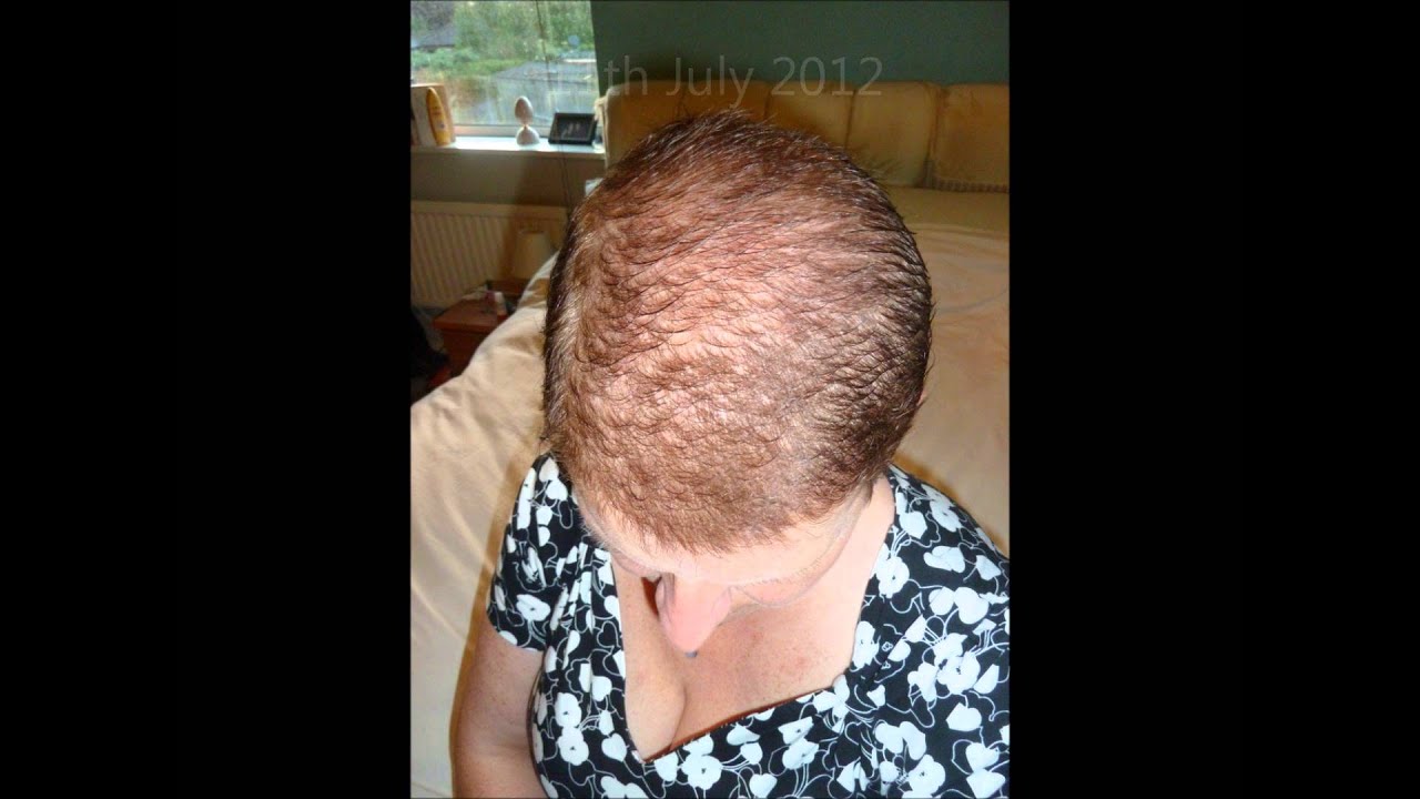 Hair regrowth video after chemotherapy YouTube