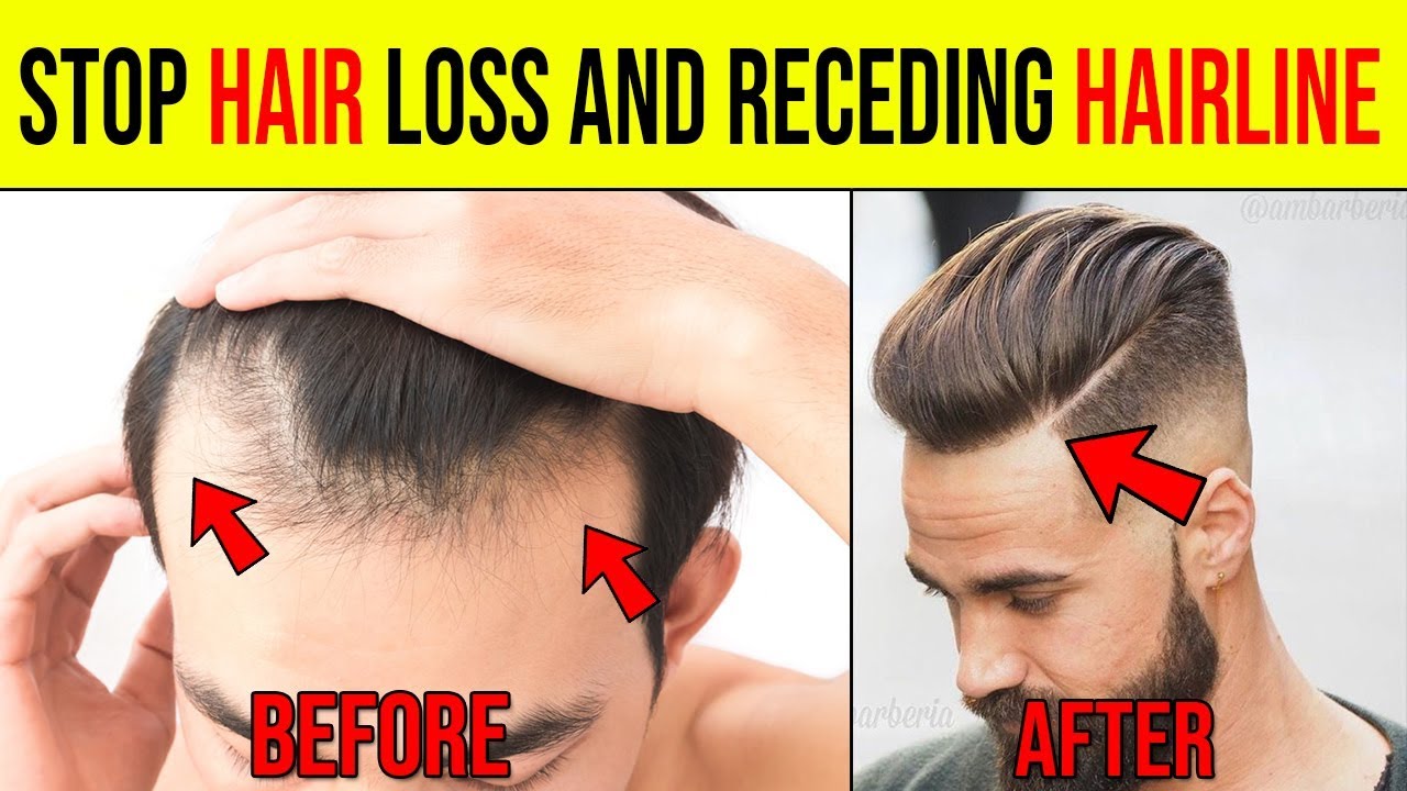 How To Stop Receding Hairline Haircut And Regrow Hair Naturally At Home